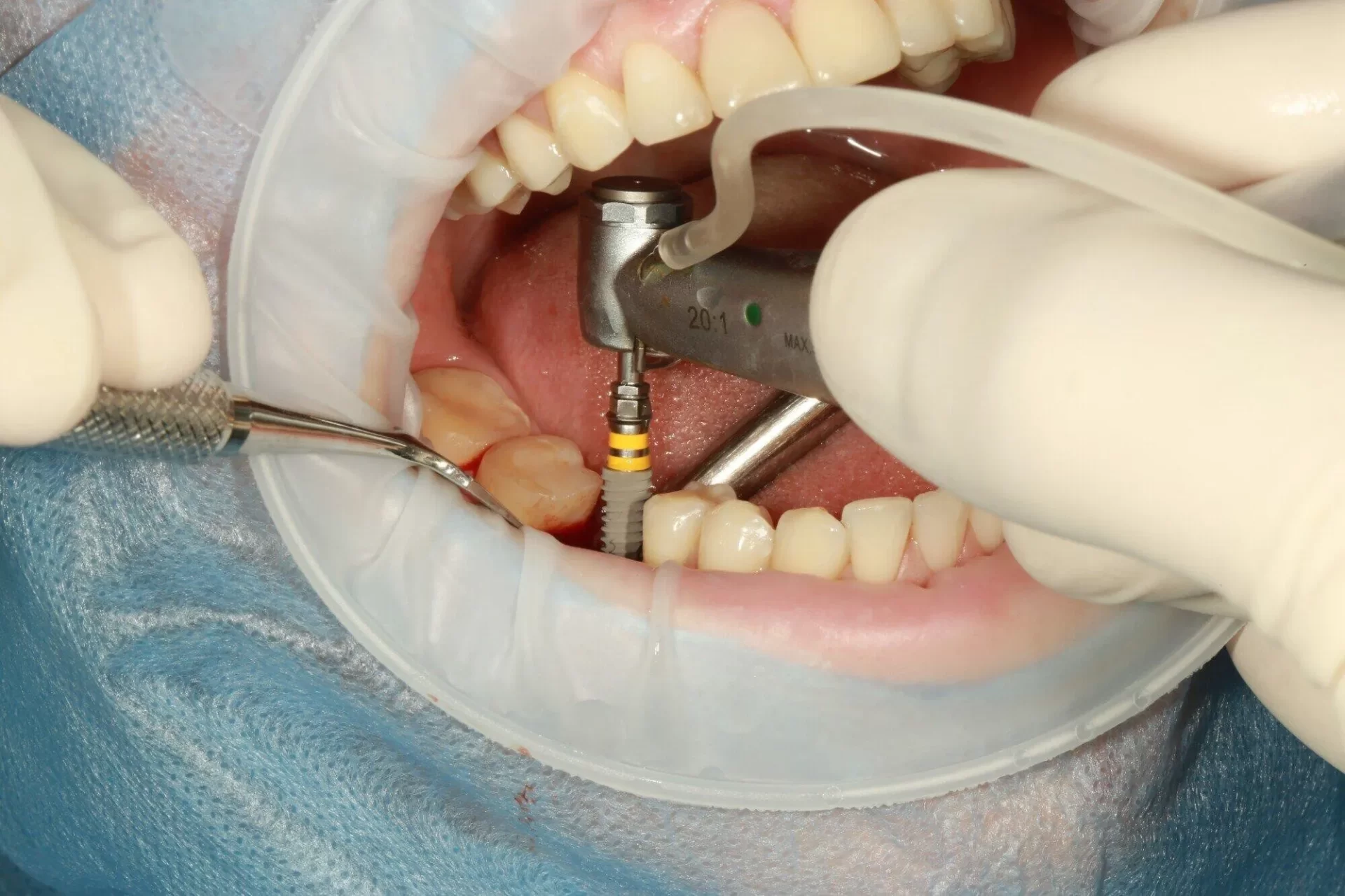 dental implants vs veneers